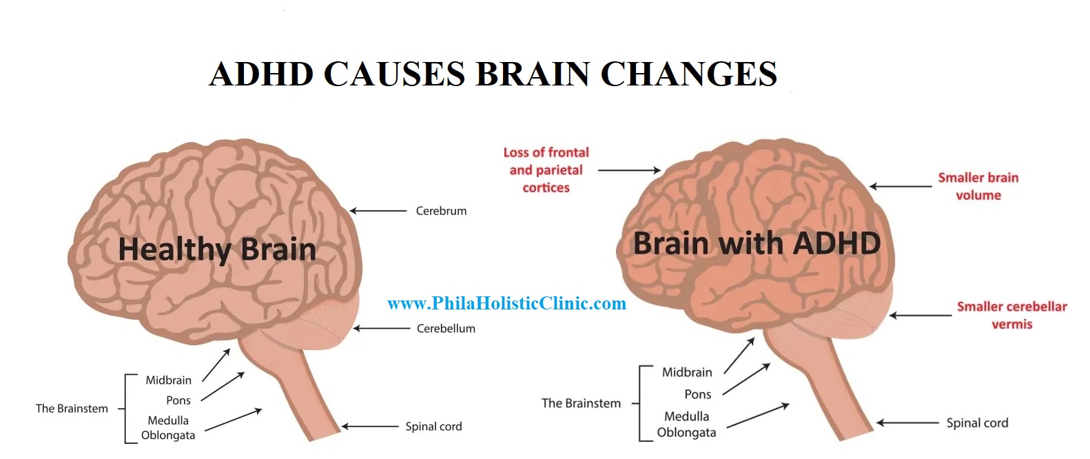 Adhd Brain Structure