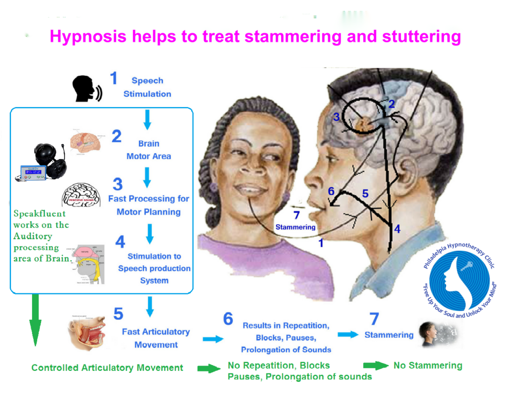 Hypnosis reduces stuttering
