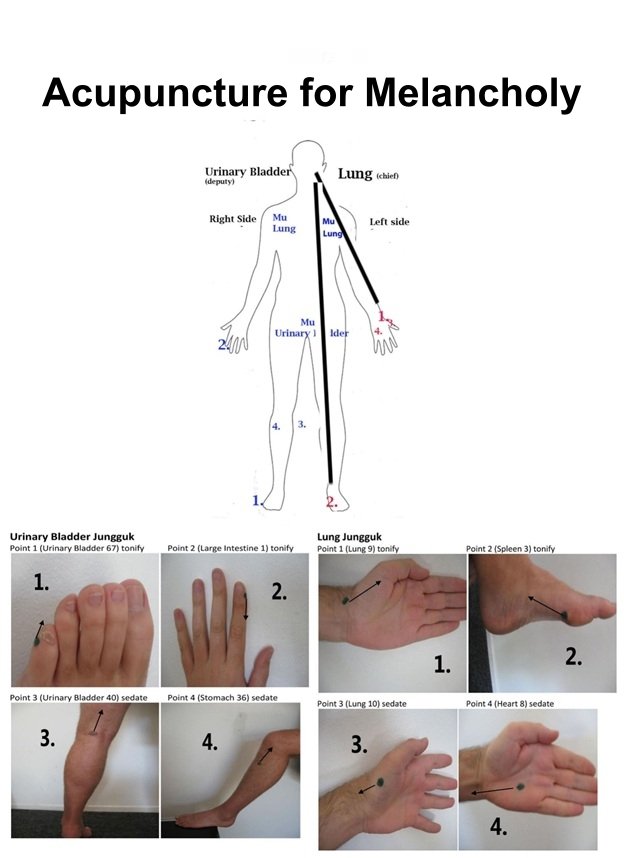 Acupuncture for Melancholic Depression